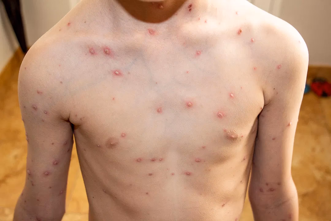 What do you need to know about chickenpox and air travel?