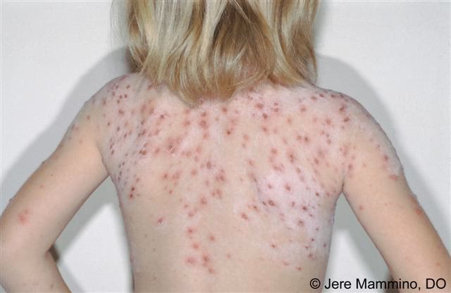 Is chickenpox a common childhood affliction?