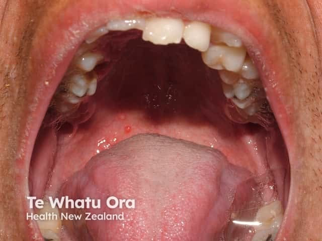 Can chickenpox spread to your mouth?