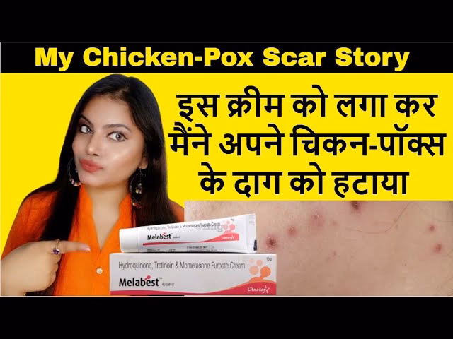 चेचक या चिकन पॉक्स के पारंपरिक उपचारों में धनिया का नाम क्या है?