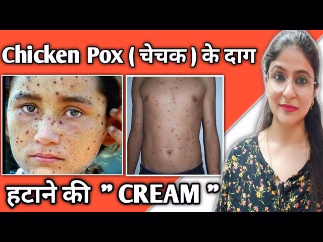 चेचक या चिकन पॉक्स के पारंपरिक उपचारों में धनिया का नाम क्या है?