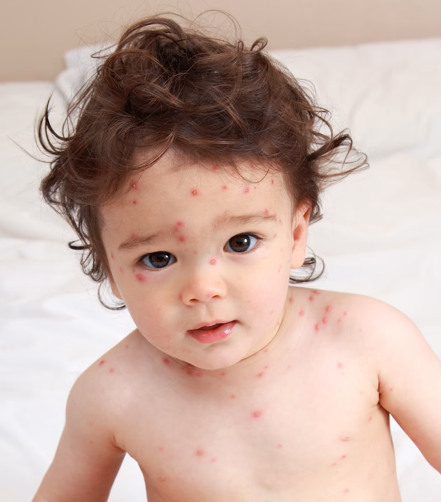 Where did chickenpox come from?