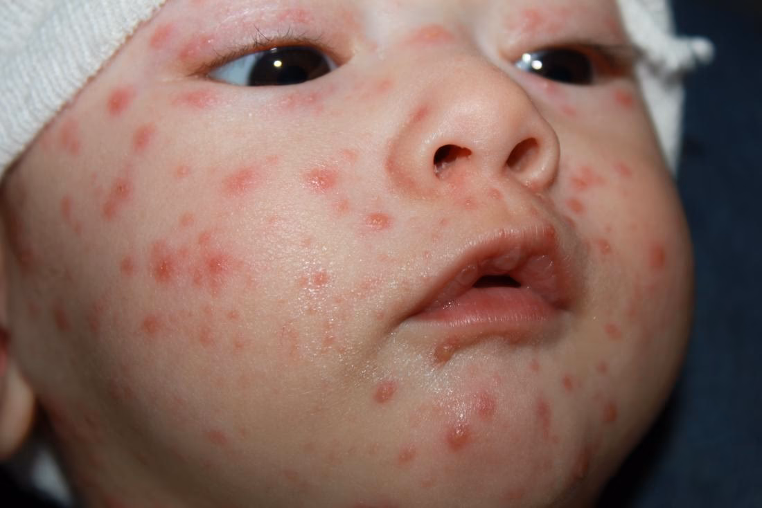 Is VzG a prophylaxis for neonate chickenpox?