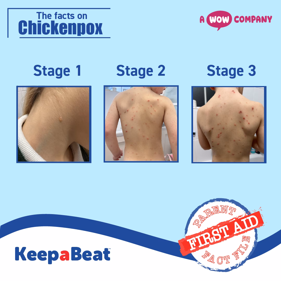 What are the stages of chicken pox rash?