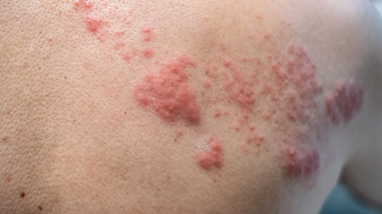 Is chickenpox still around?