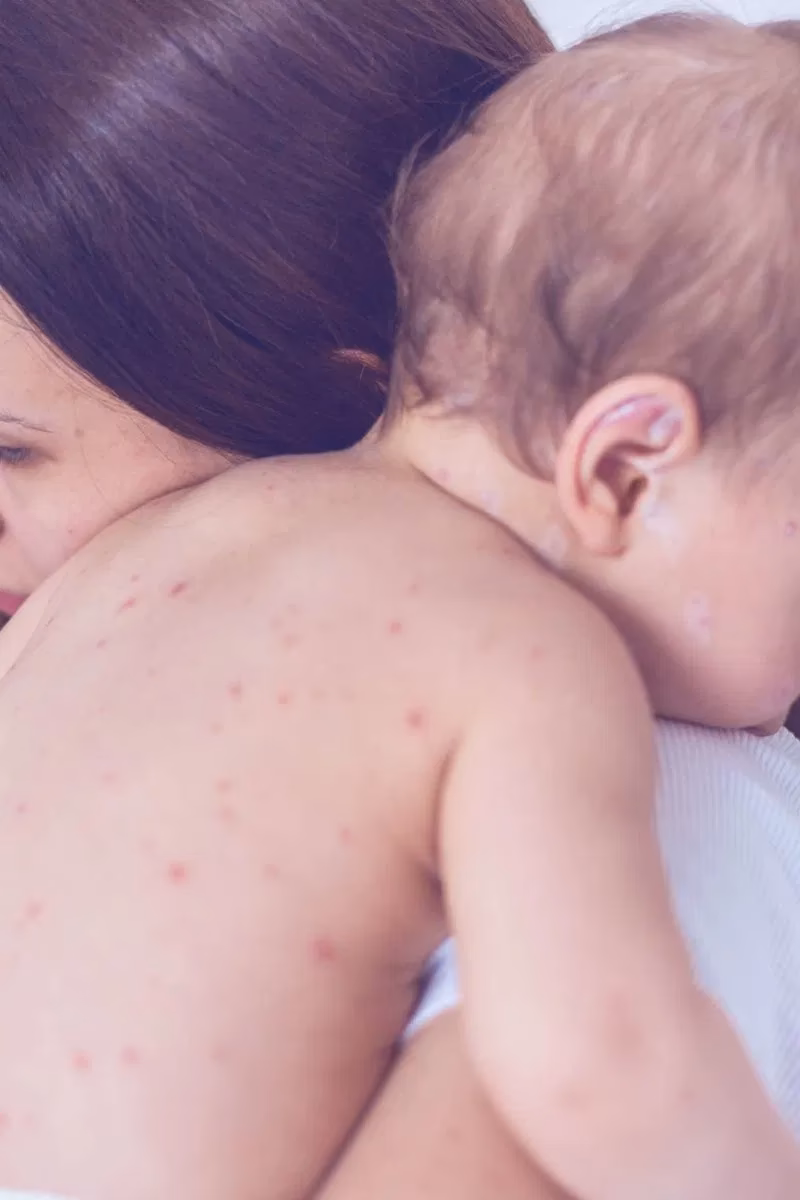 How long does chickenpox last in children?