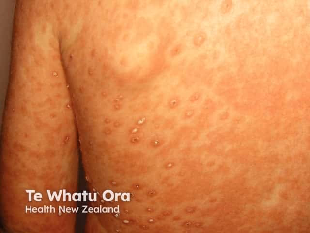 What are the early symptoms of chickenpox?