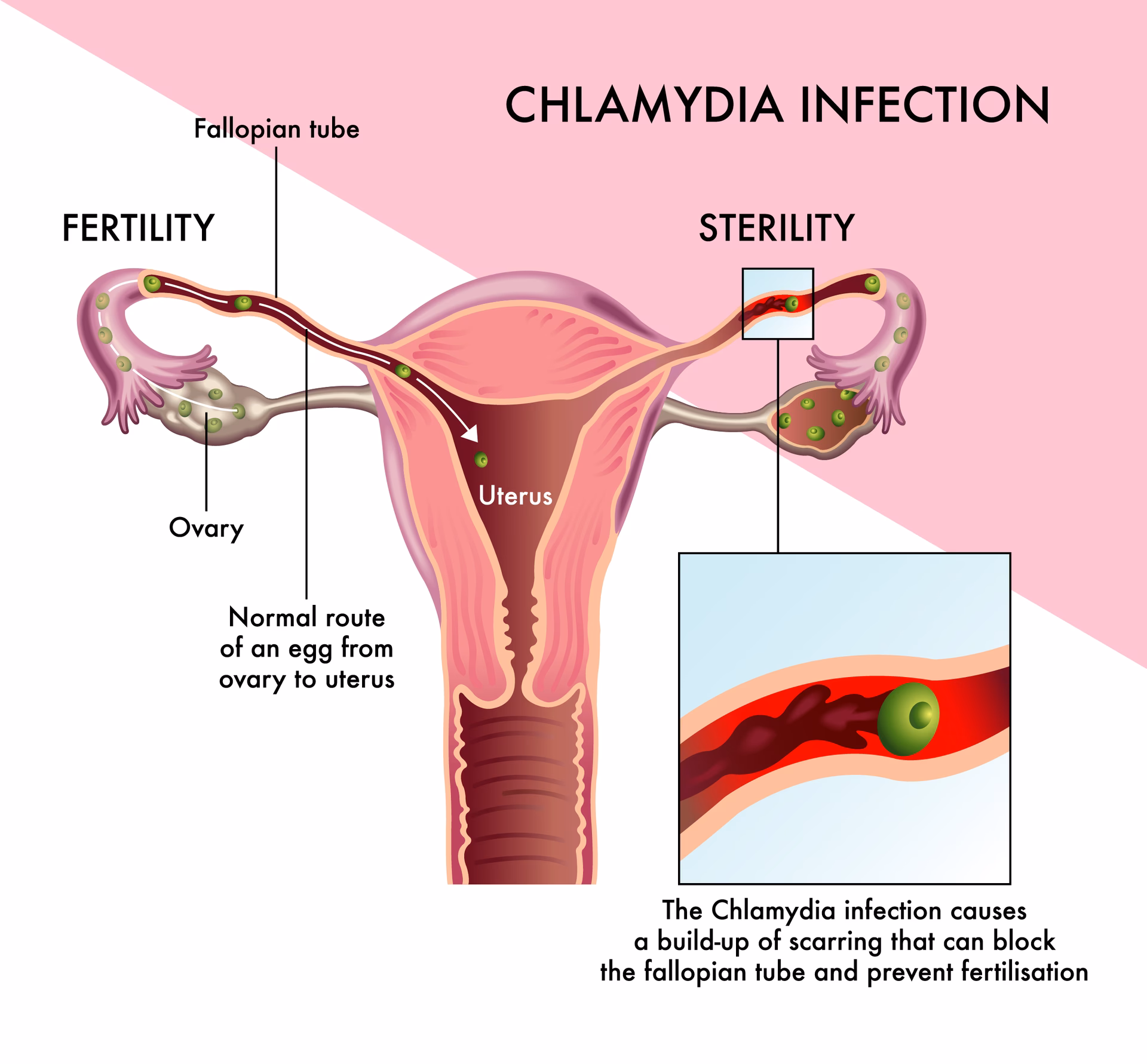 Is chlamydia a sexually transmitted infection?