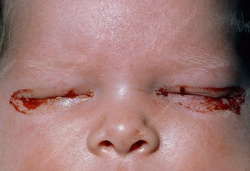 Does silver nitrate affect neonatal chlamydial infection?