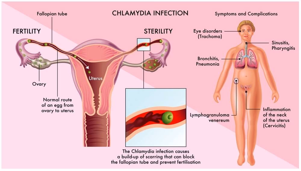What is chlamydia/Neisseria gonorrhoeae RNA?