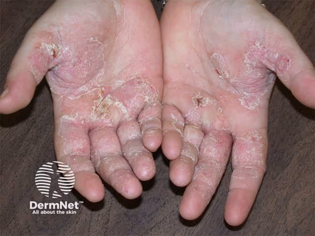Can chromium salts cause a contact allergic dermatitis?