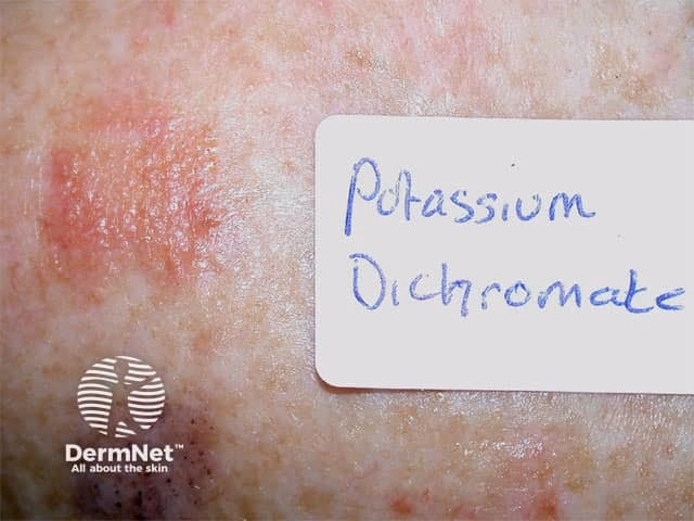 Can chromium salts cause a rash?