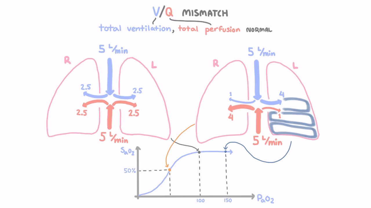 Does V / Q mismatch affect lung edema in patients with Ards?