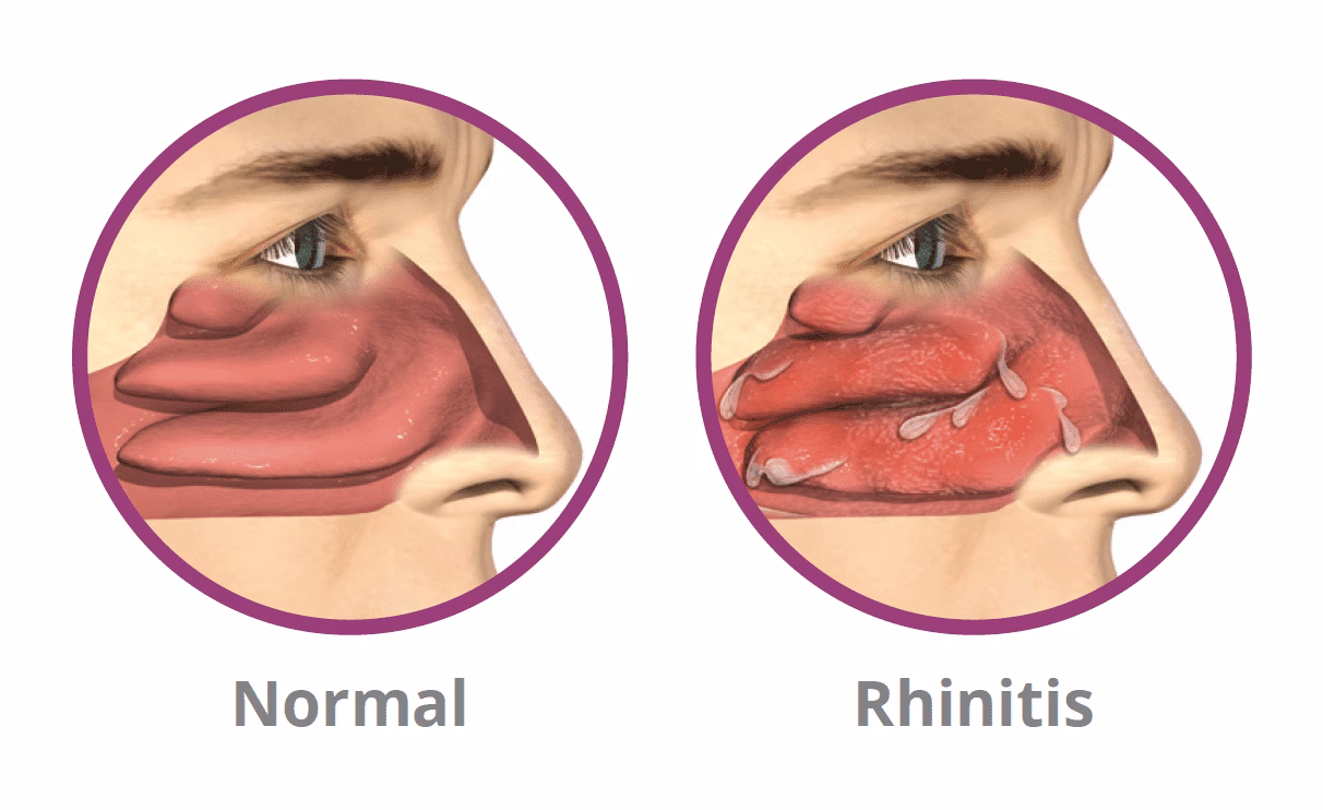 What does rhinorrhea mean?