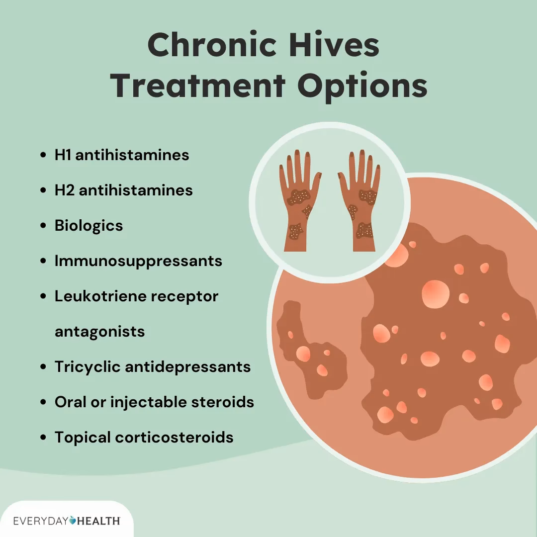 What is the treatment for chronic urticaria?