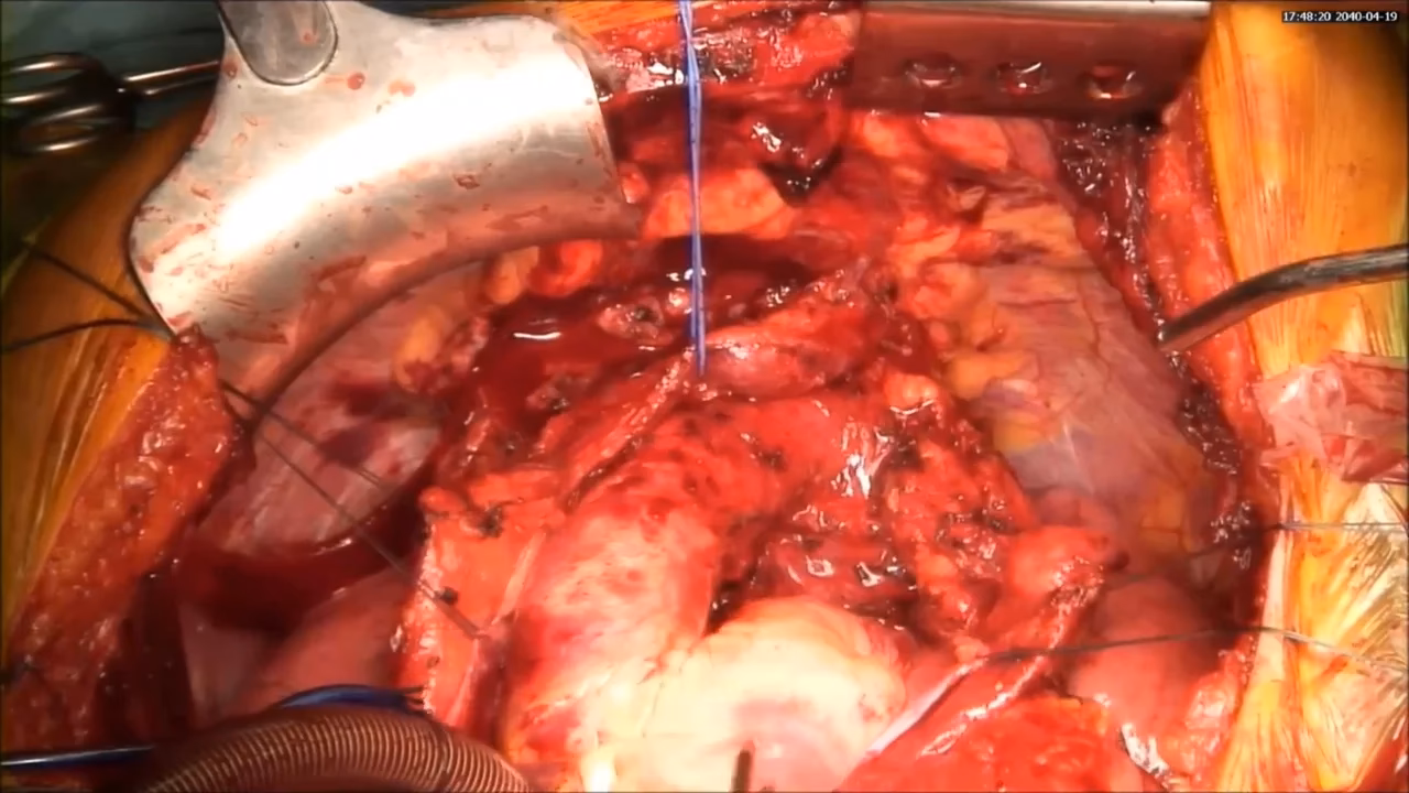 What is a clamshell thoracotomy?