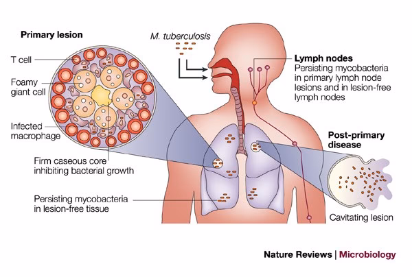 Which statistical classification is used for tuberculosis?
