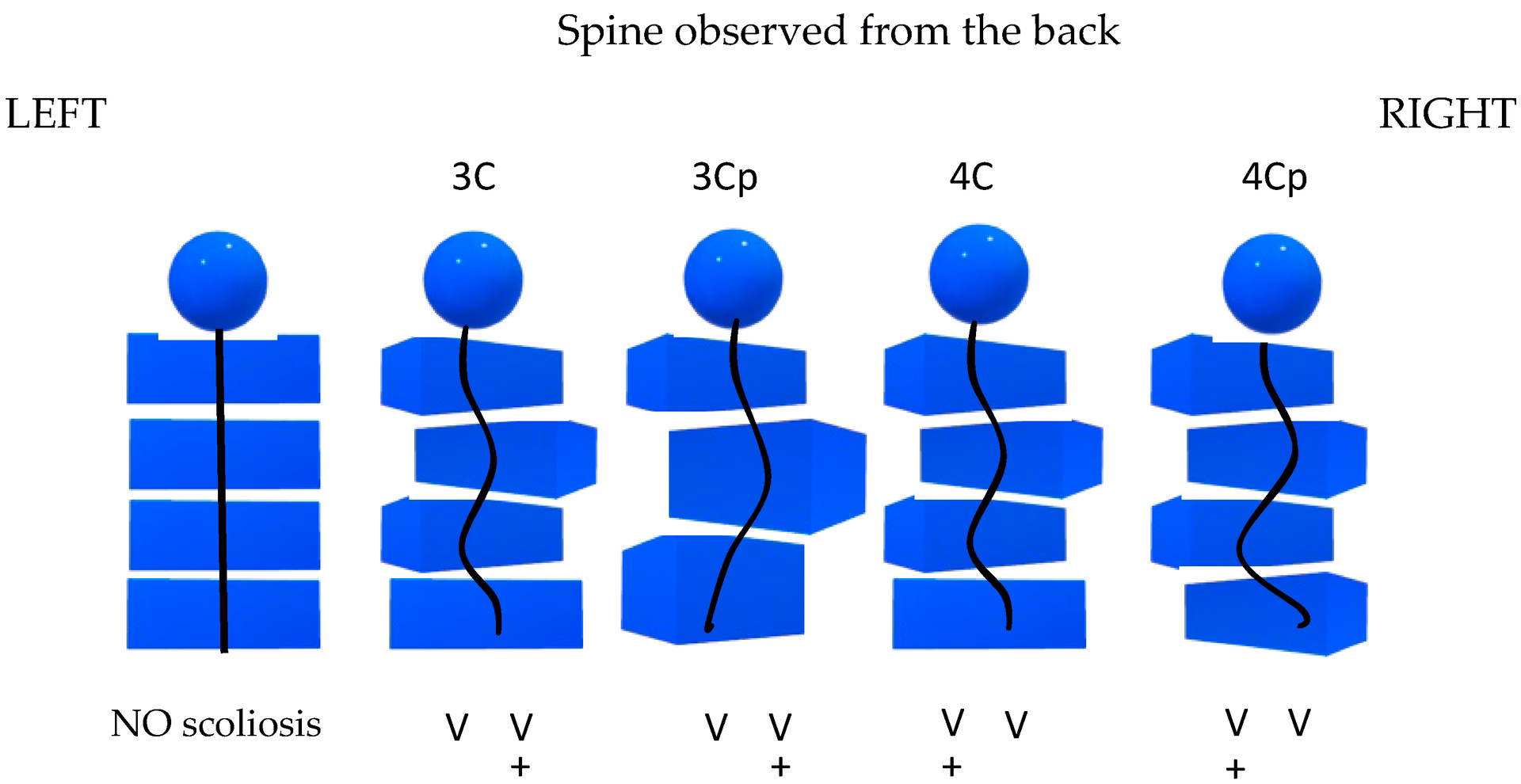 How is adolescent idiopathic scoliosis classified?