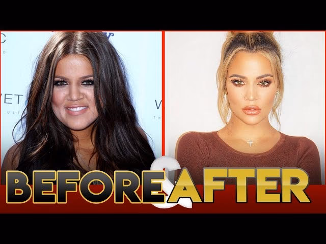 Did Chloe Ferry get teeth whitening?