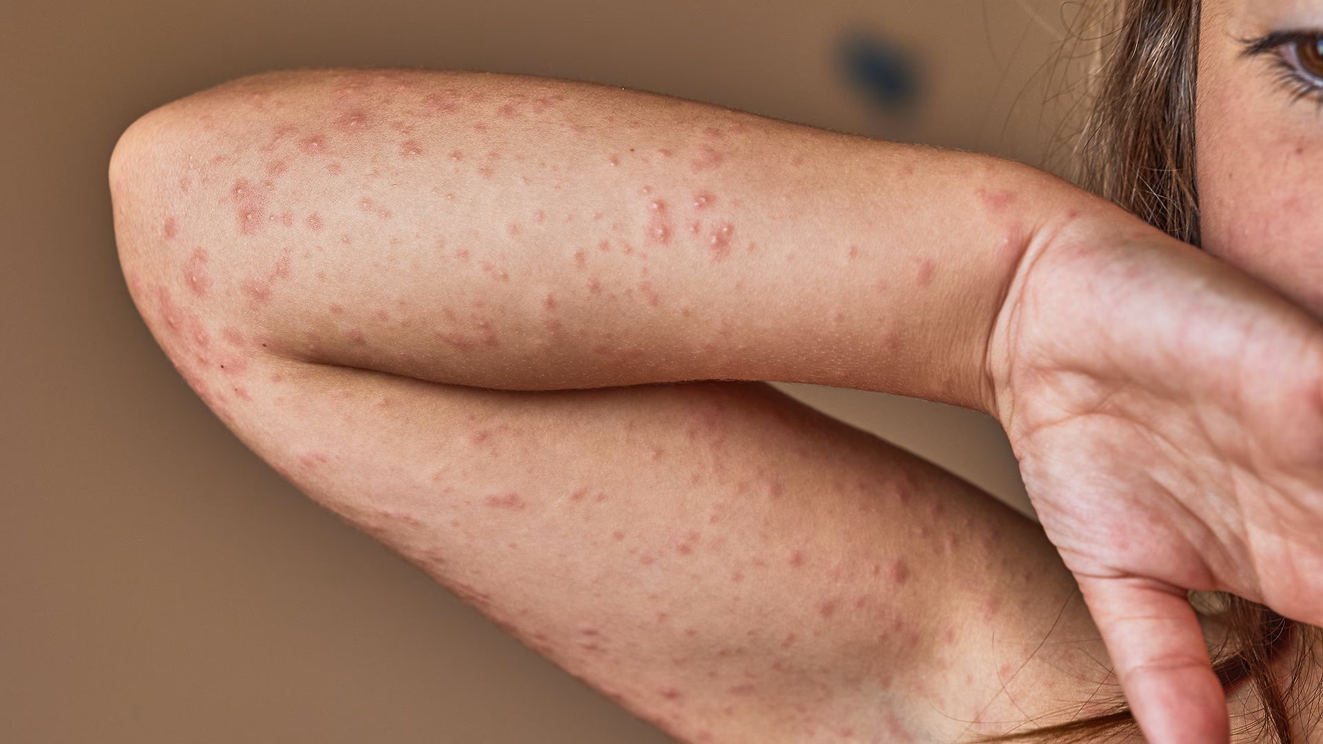 Does cloxacillin cross-react with other betalactam antibiotics?
