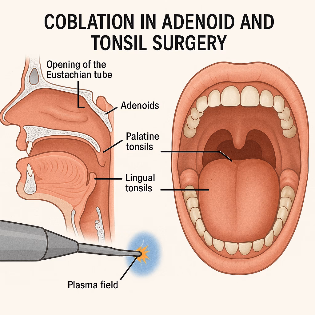 What is a coblation tonsillectomy & adenoidectomy?