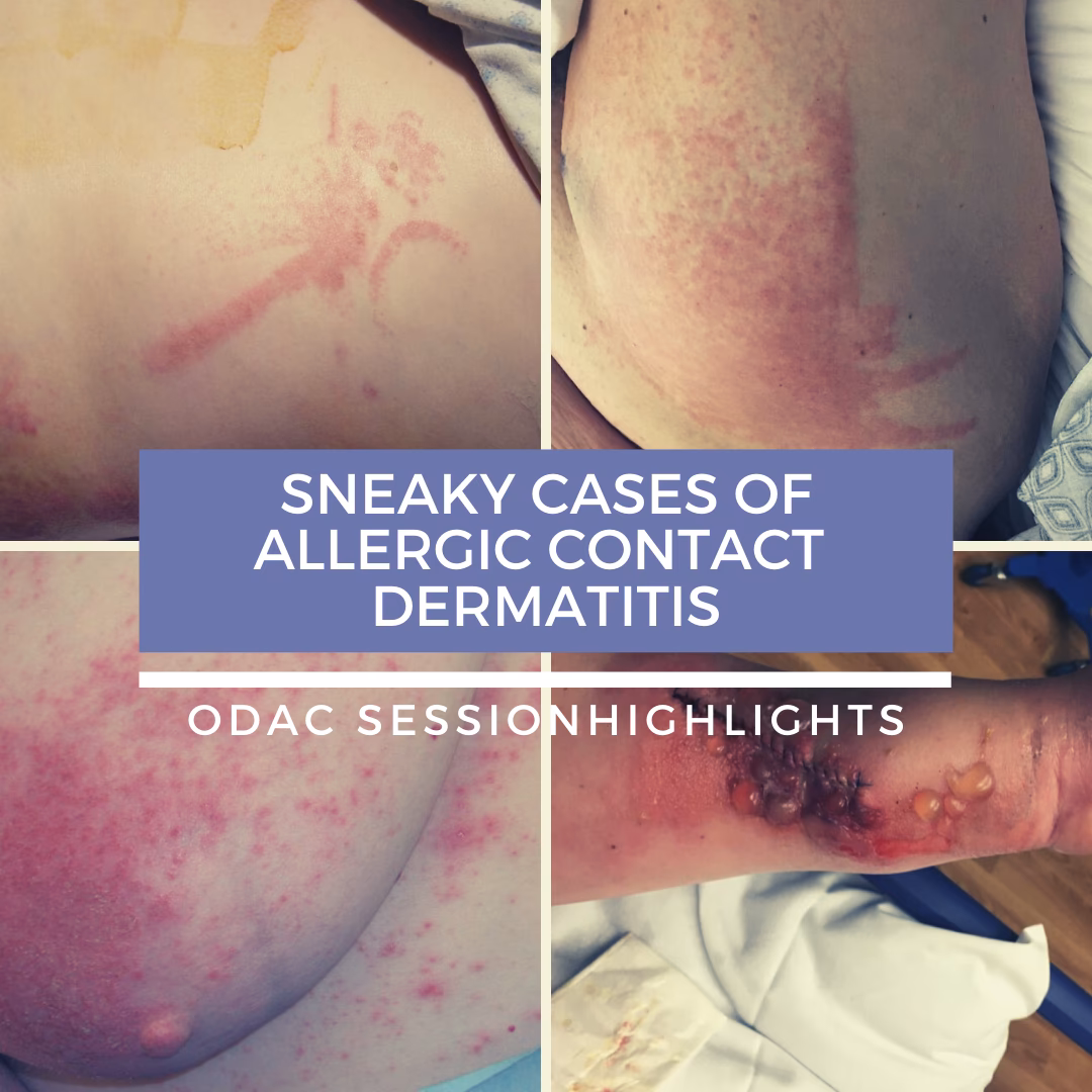 Is cocamidopropyl betaine a contact allergy?