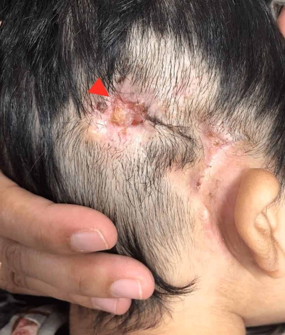 How common is surgery for cochlear implantation?