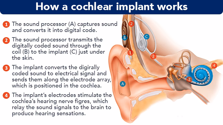 Is cochlear implantation a safe procedure?