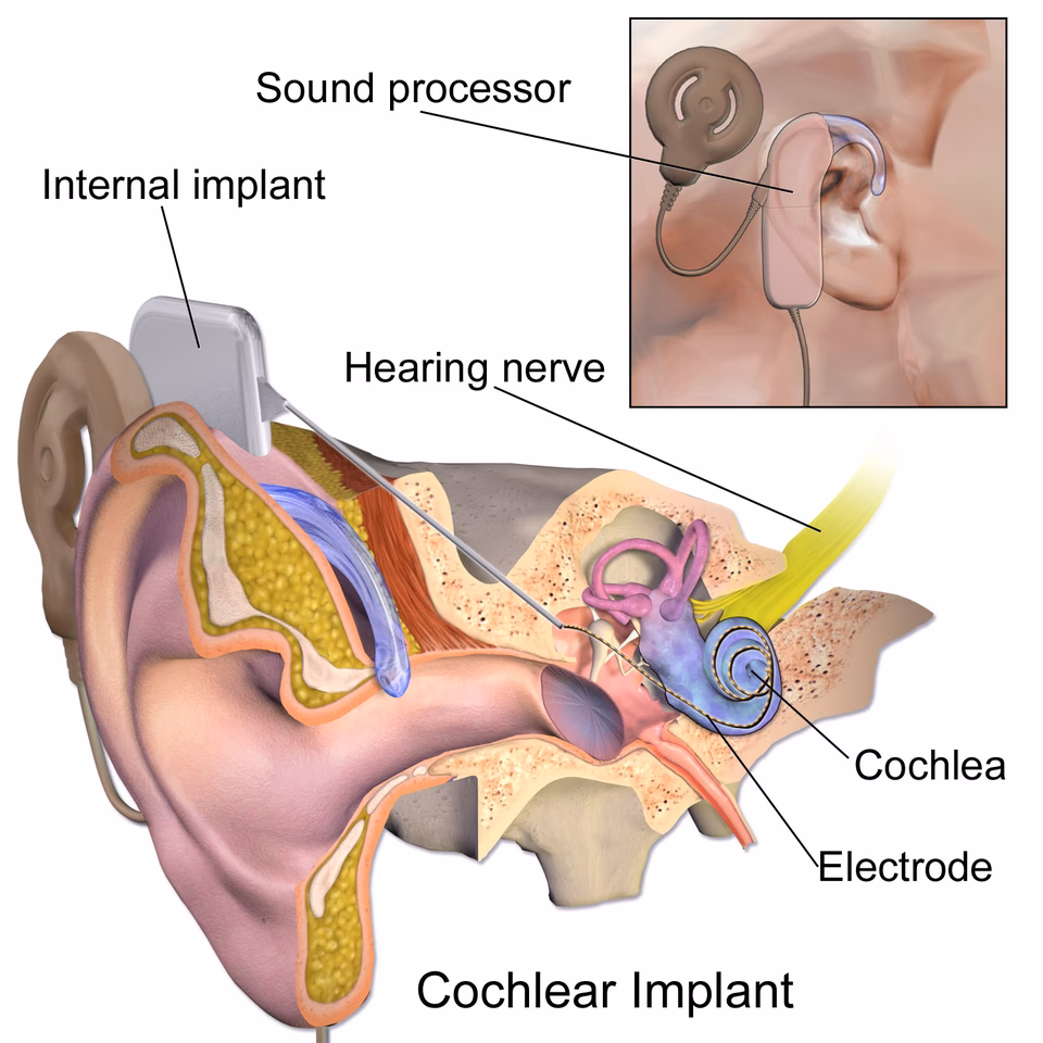 Are there any risks associated with cochlear implantation?