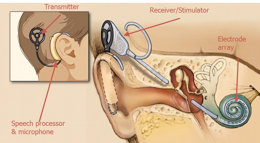 Should I get a cochlear implant?