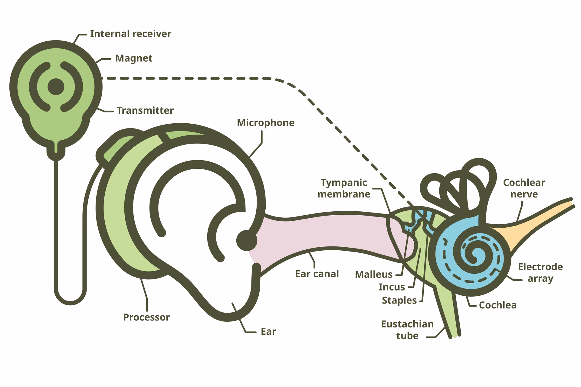 Can a cochlear implant help with hearing loss?