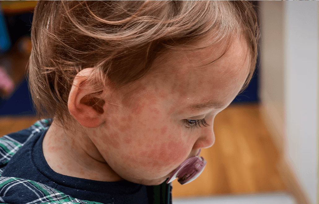 How do I know if my child has allergies?