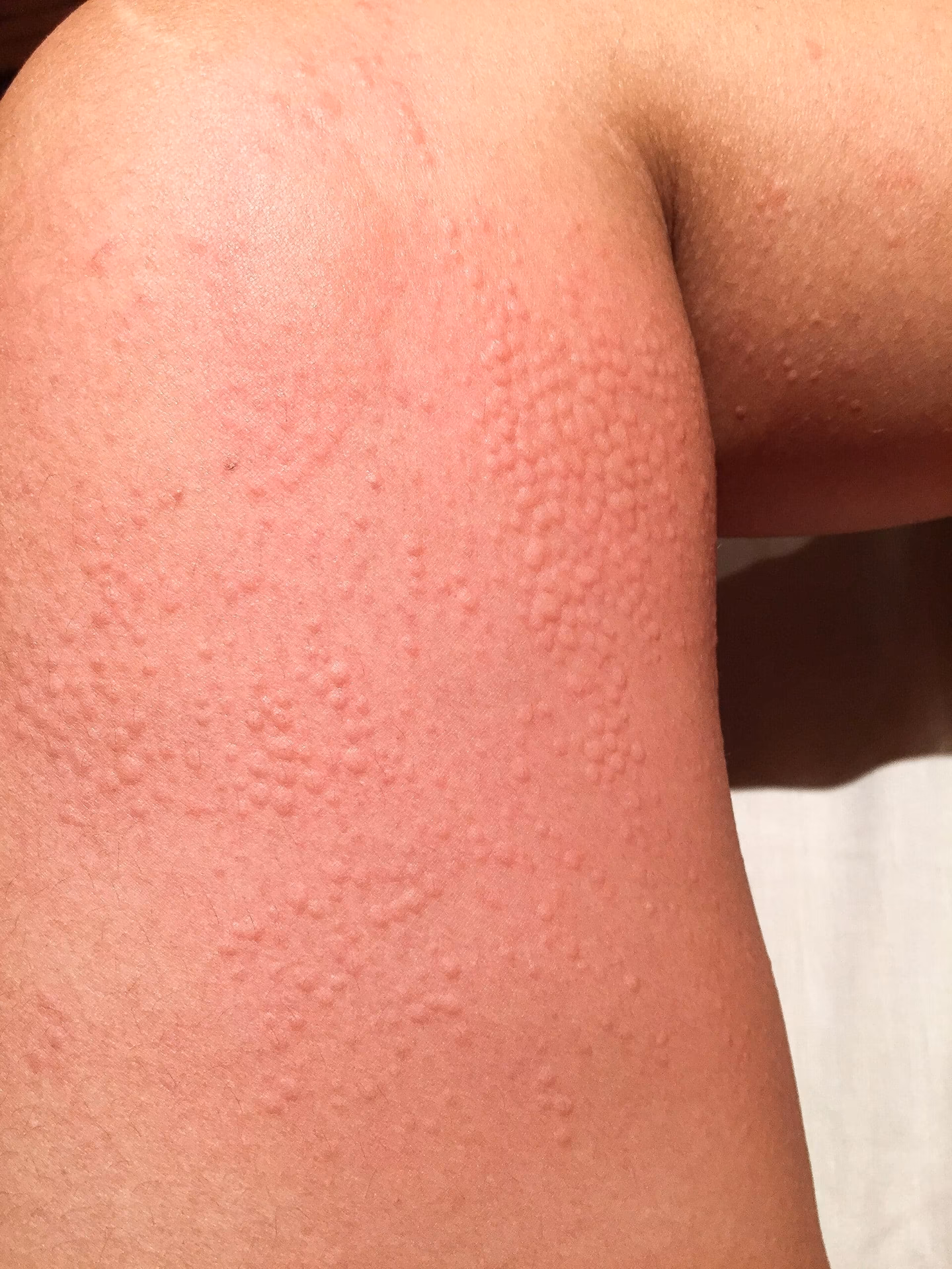 What causes hives & cold rash?