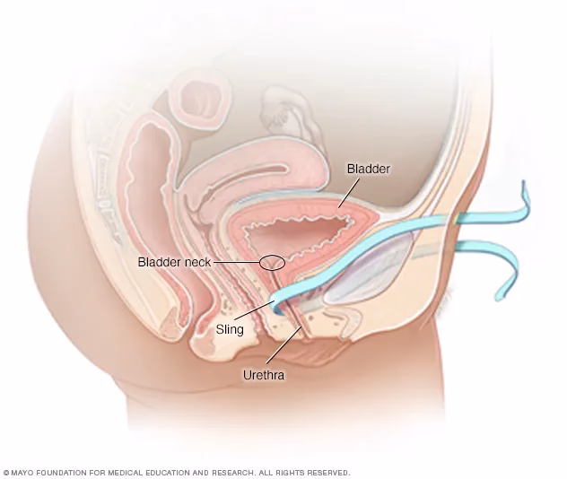 Can bladder sling surgery cause a complication?
