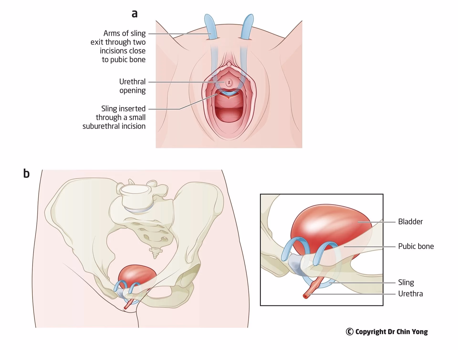 What is a stress urinary incontinence sling?