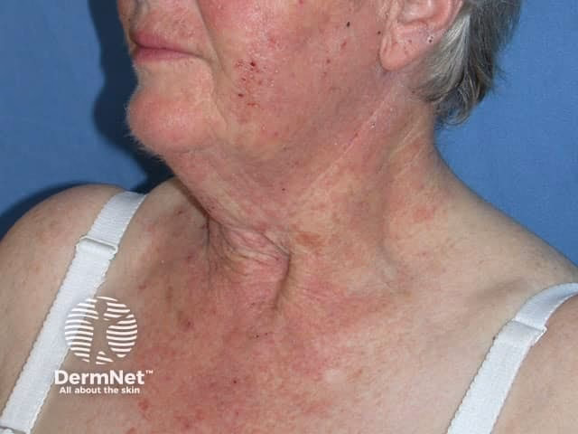 Which plant allergens are associated with Compositae allergy?