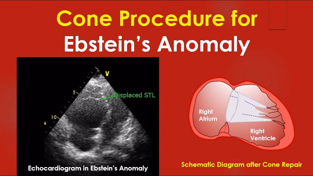 What is the cone procedure in Ebstein anomaly?