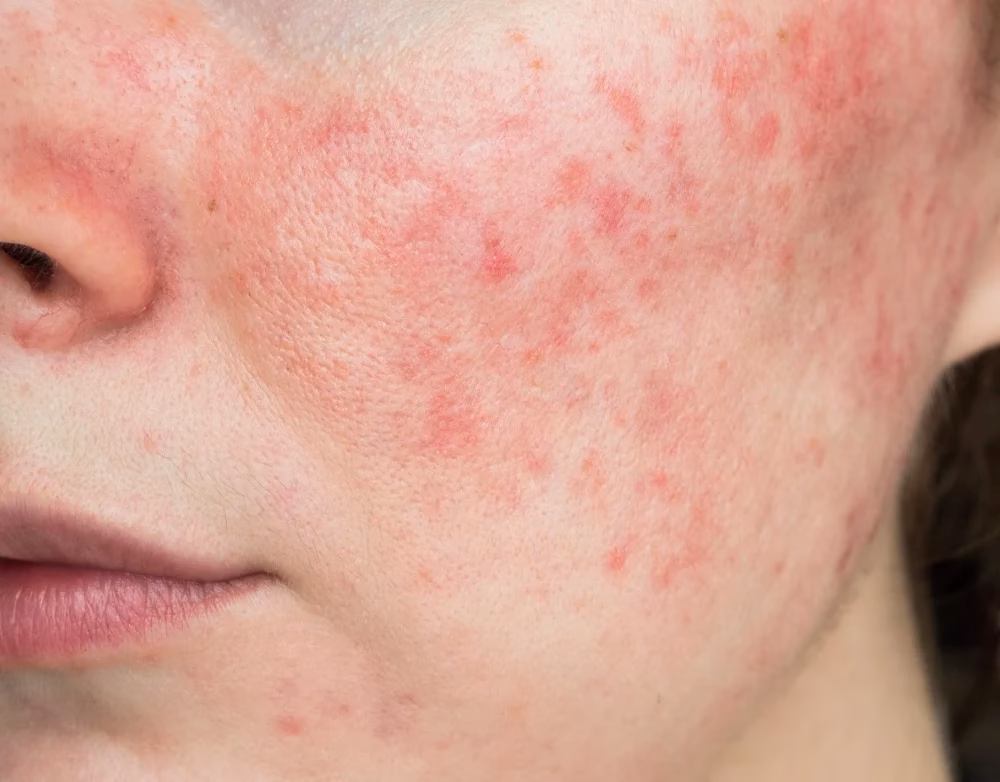 Is a rash a sign of contact dermatitis?