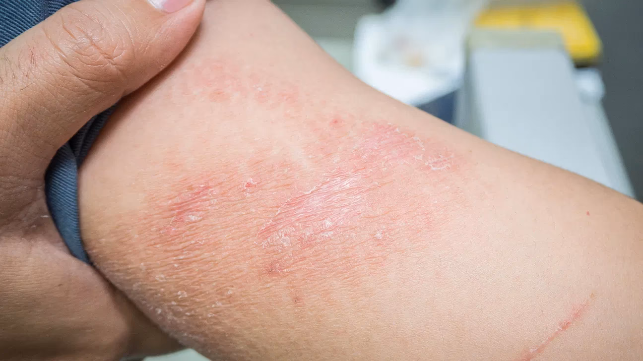 How do you treat contact dermatitis rash?