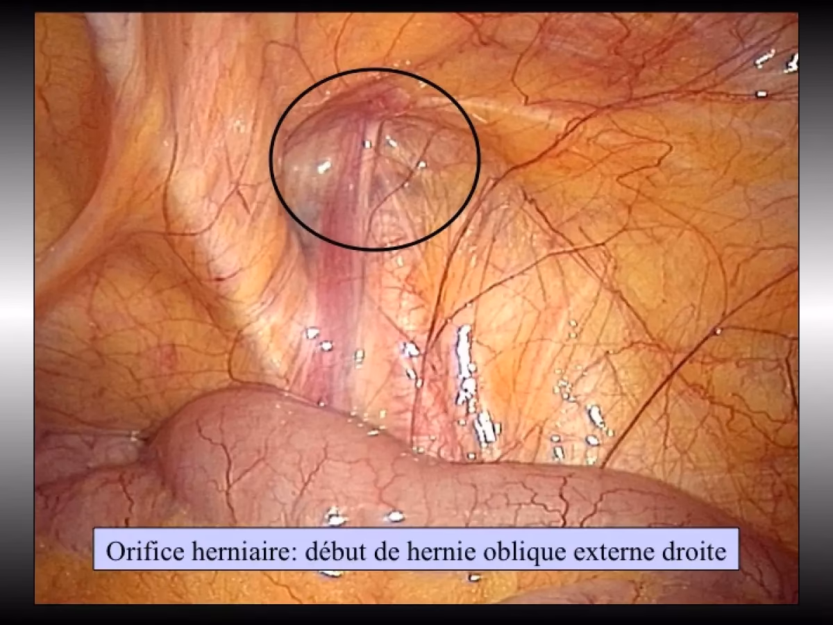 Combien de temps faut-il pour guérir une hernie inguinale ?