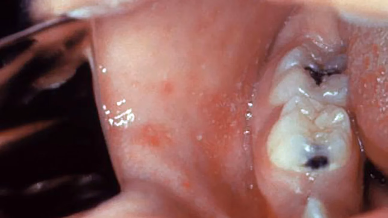 Is measles still a problem?