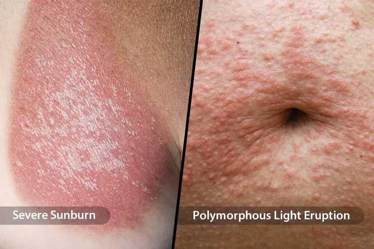 Can sunburn make you sick?