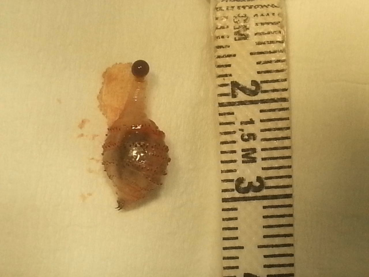 Why do I cough up Brown phlegm?