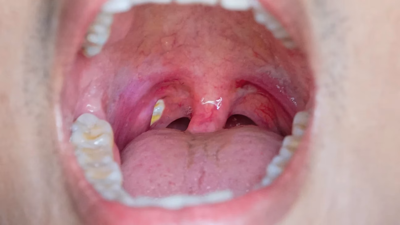 Why is my mucus coughing up fleshy chunks?