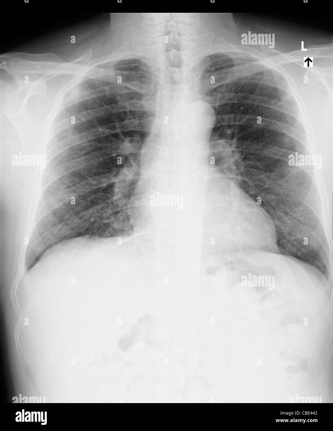Why should I get an X-ray if I have a cough?