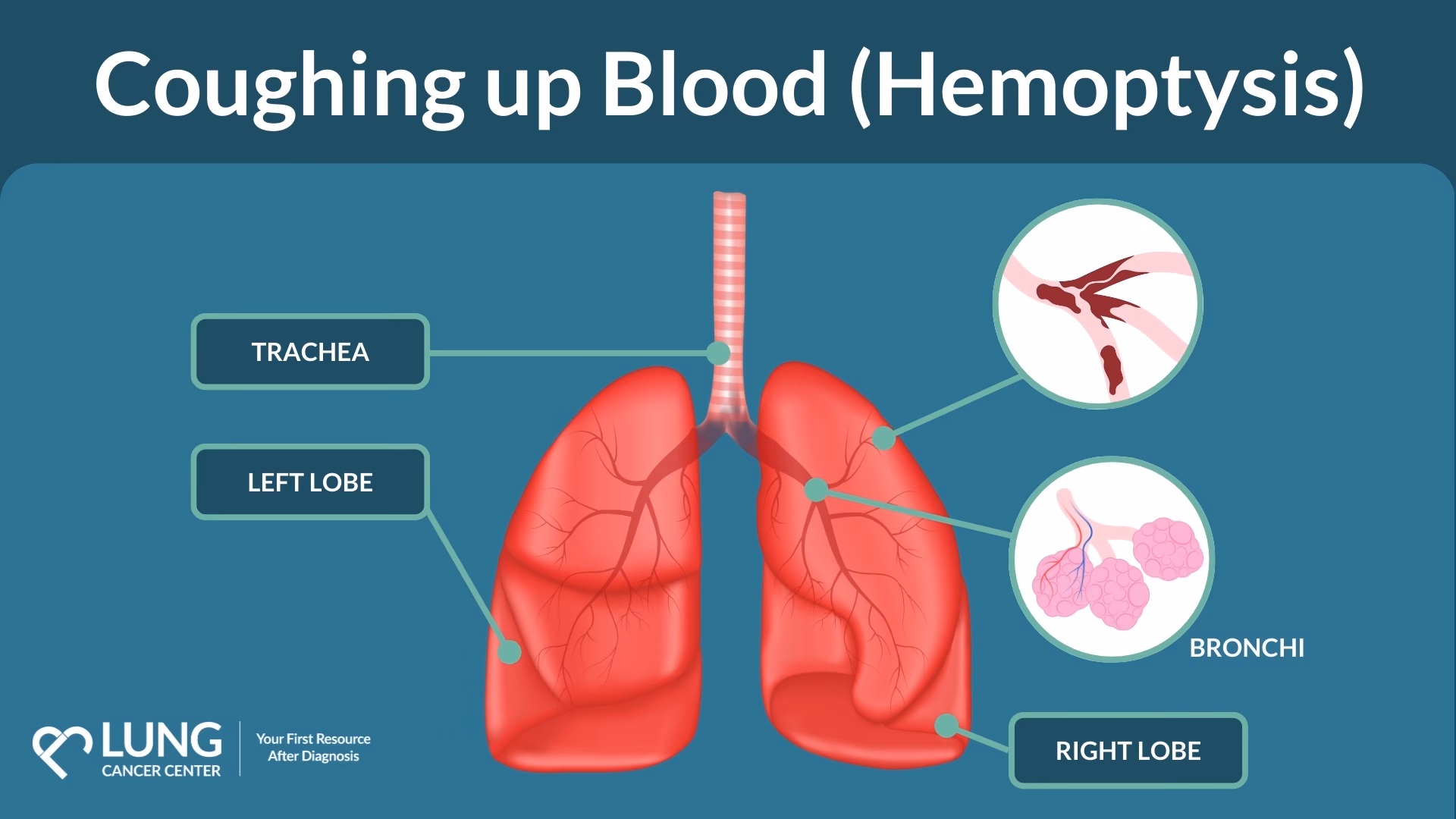 Is coughing up blood a sign of lung cancer?