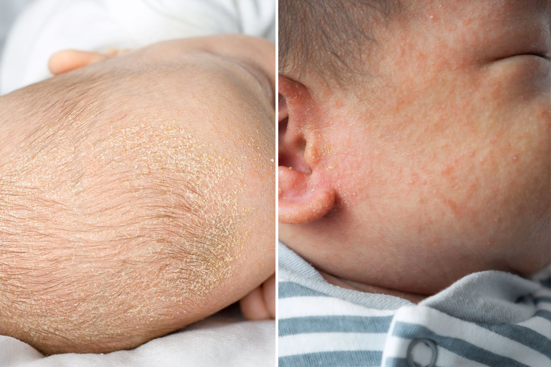 How common is cradle cap?