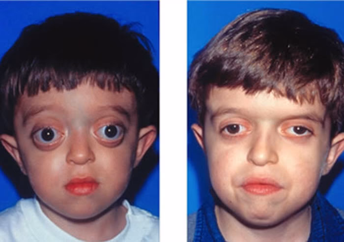 Where can I get a surgical report for Crouzon syndrome?