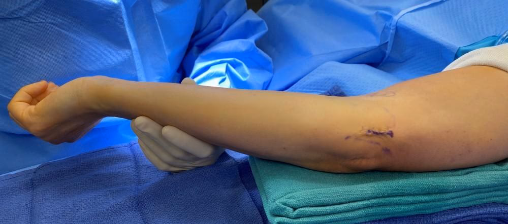 What are the different types of cubital tunnel surgery?