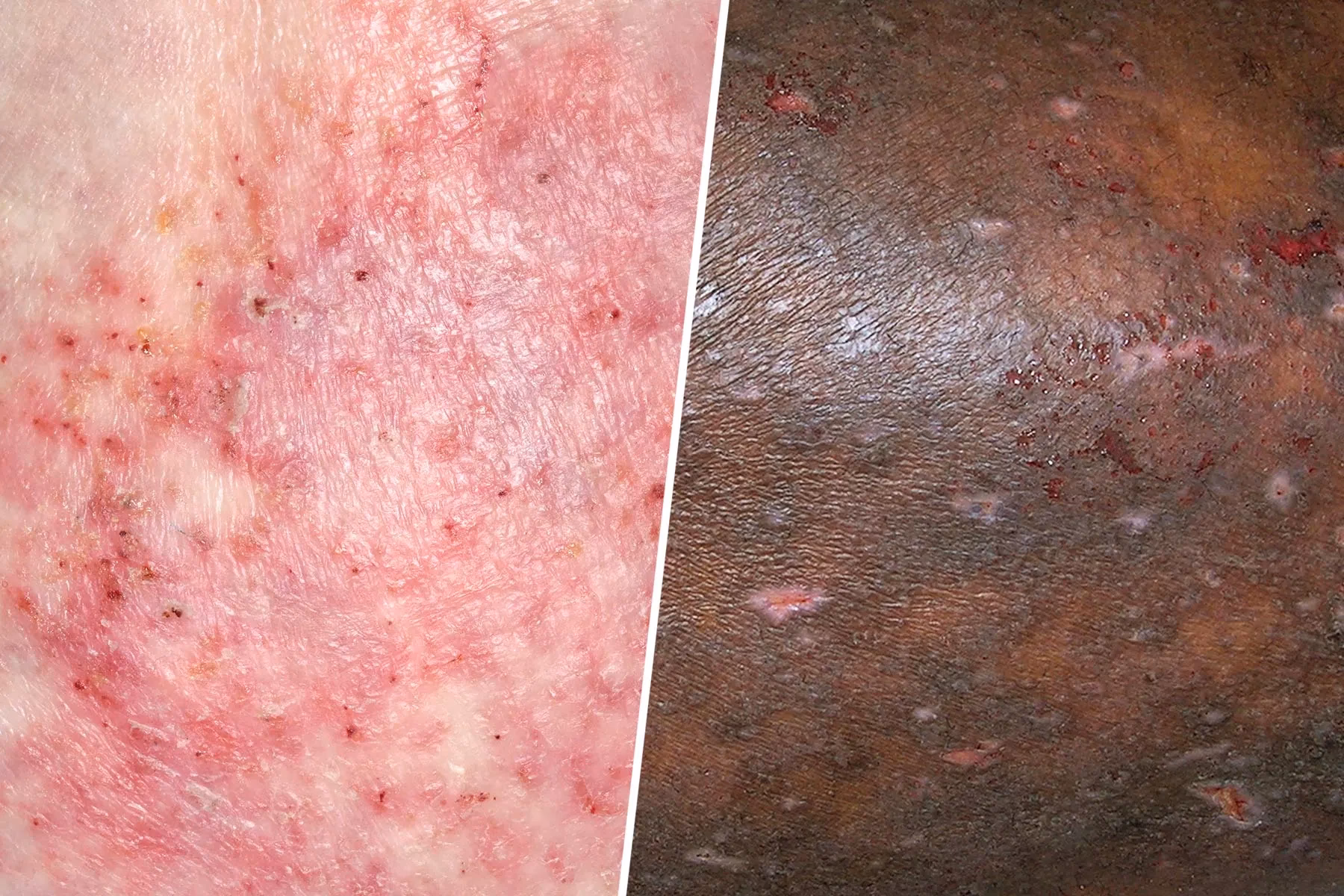 Can eczema be cured?